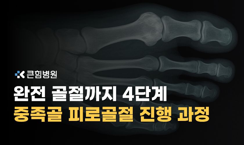 중족골 피로골절 증상과 진행 단계에 따른 치료 어떻게 진행되나요?
