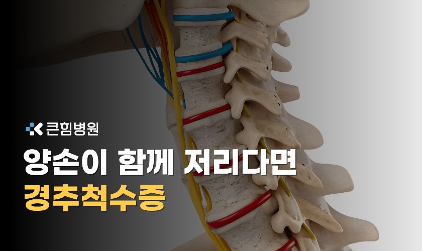 부산목통증 뒤에 숨은 경추척수증