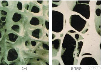 골다공증(osteoporosis)