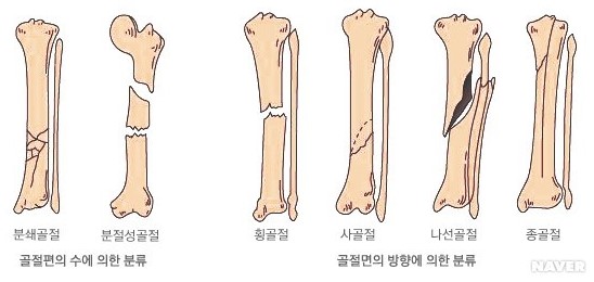 골절(fracture)
