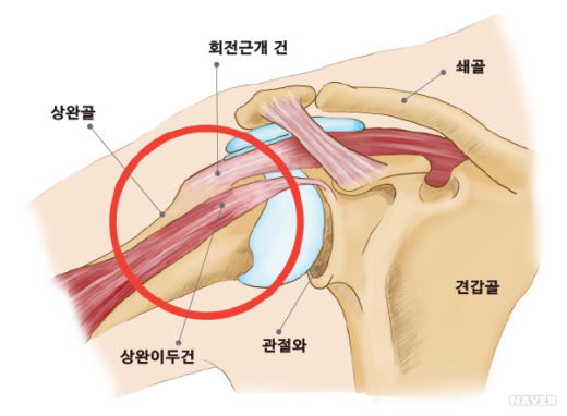 어깨충돌증후군(Shoulder impingement syndrome)