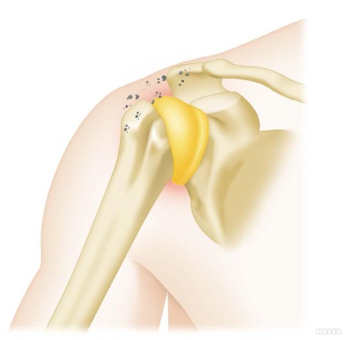 석회성건염(Calcific tendinitis)
