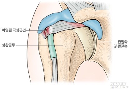 어깨관절 재발성 탈구(recurrent dislocation of shoulder)