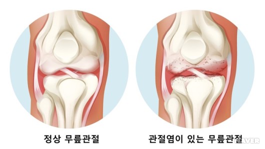 무릎 관절염(Osteoarthritis of knee)