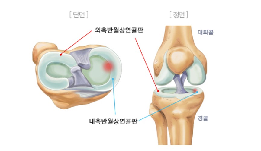 반월상 연골판 손상(Meniscus tear)